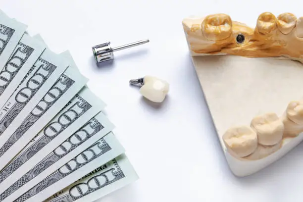 Understanding All on 4 Dental Implants Cost: A Comprehensive Guide
