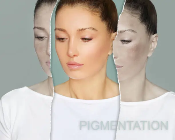 Effective Pigmentation Treatment Solutions at Cronulla Skin Sanctuary