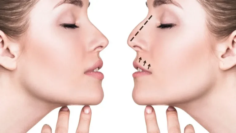 Understanding the Rhinoplasty Procedure: What to Expect and How It Can Transform Your Appearance