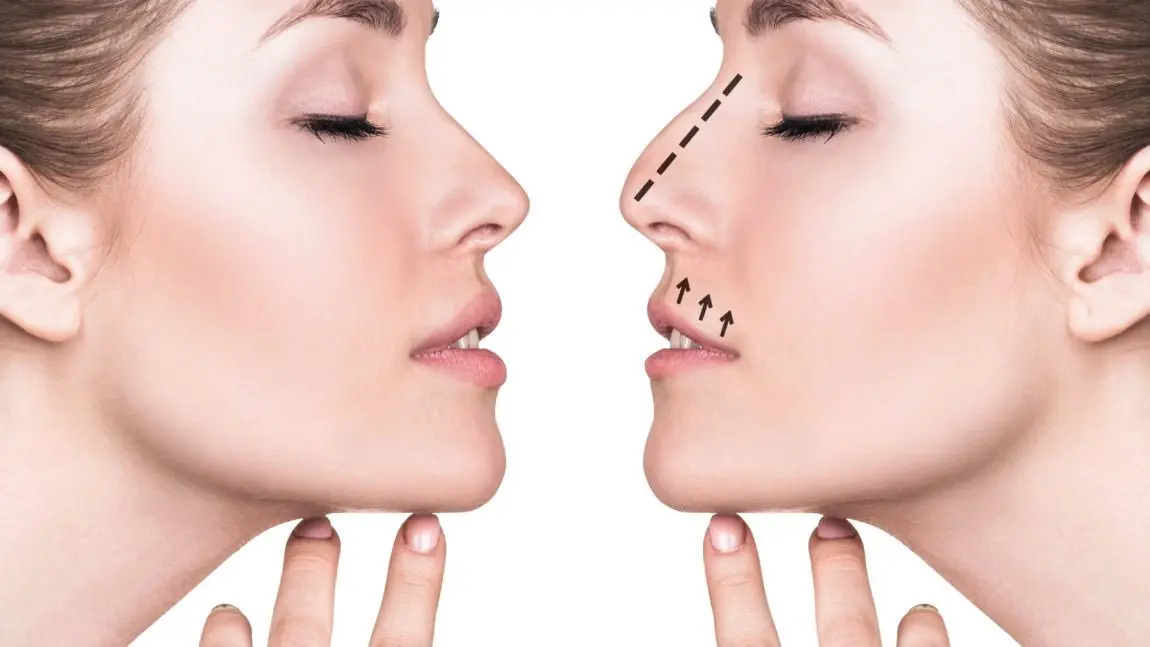 Understanding the Rhinoplasty Procedure: What to Expect and How It Can Transform Your Appearance