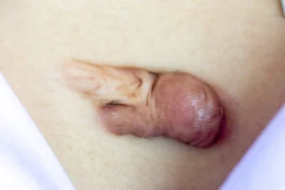 Understanding Pearly Penile Papules and Removal Options