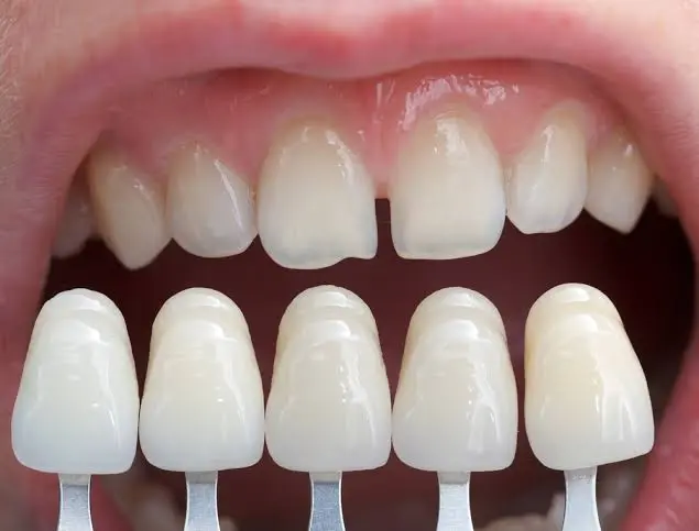 Are Porcelain Veneers Worth It? What They Cost, Fix, and Last