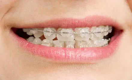 Why Clear Braces Are Becoming Increasingly Popular