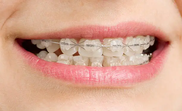 Why Clear Braces Are Becoming Increasingly Popular